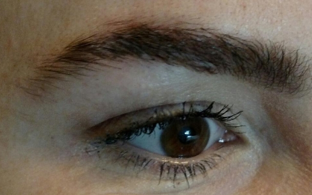 Scar after